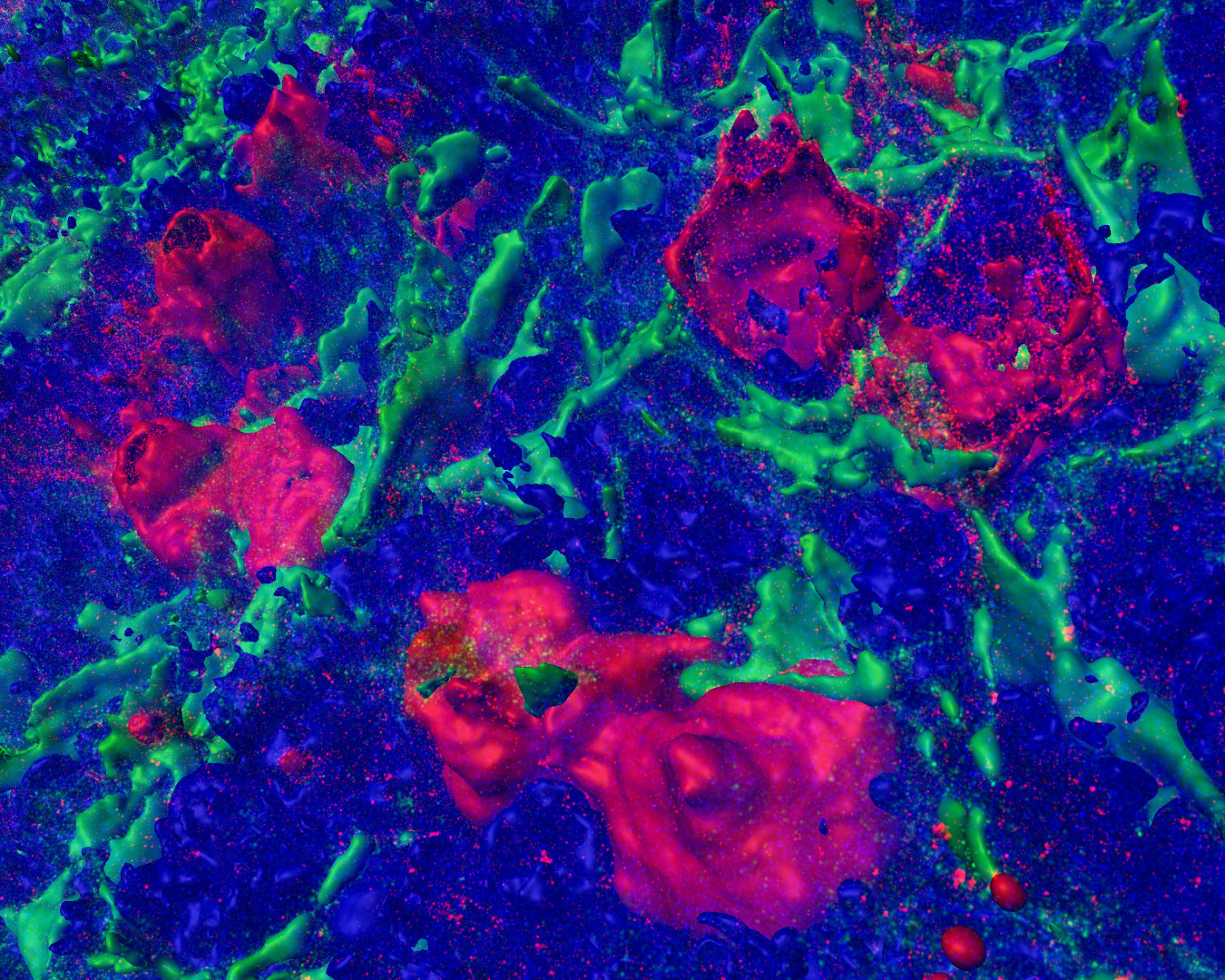 three-dimensional view of several red-labelled CD30-positive lymphocytes in an inflamed lymph node